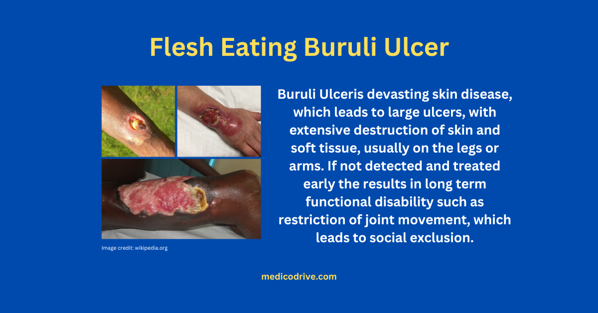 Flesh-eating Buruli ulcer: Cases suddenly increased in Australia, know what it is